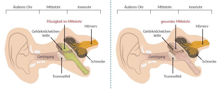 Vergleichende Illustration des menschlichen Ohrs: Links ein Mittelohr mit Flüssigkeitsansammlung, rechts ein gesundes Mittelohr.