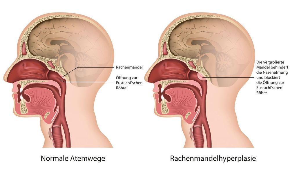 Medizinische Illustration, die einen Querschnitt der Atemwege zeigt. Links normale Atemwege, rechts eine vergrößerte Rachenmandel (Rachenmandelhyperplasie), die die Nasenatmung behindert und die Öffnung zur Eustachischen Röhre blockiert.