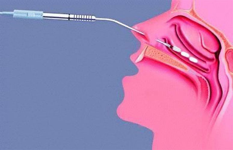Medical illustration of a minimally invasive nasal procedure using a specialized instrument inserted into the nasal cavity.